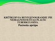 Prezentācija 'Pacienta aprūpe, veicot krūškurvja rentgenogrammu pie nediagnosticētas plaušu tu', 1.