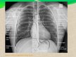 Prezentācija 'Pacienta aprūpe, veicot krūškurvja rentgenogrammu pie nediagnosticētas plaušu tu', 7.
