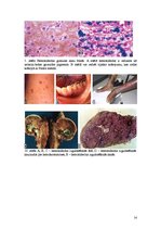 Referāts 'Hemosideroze', 14.