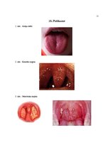 Referāts 'Skarlatīna', 15.
