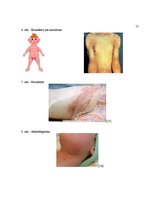 Referāts 'Skarlatīna', 17.