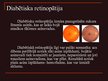 Prezentācija 'Redzes slimības', 13.