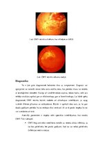 Konspekts 'Citomegalovīrusa retinītis', 5.