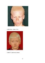 Referāts 'Albīnisms', 21.