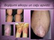 Prezentācija 'Psoriāze', 7.