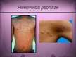 Prezentācija 'Psoriāze', 11.