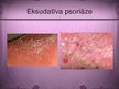 Prezentācija 'Psoriāze', 13.