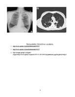 Referāts 'Hroniski obstruktīva plaušu slimība (HOPS)', 9.