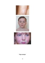 Referāts 'Ar tuberozo sklerozi slimojošu jauniešu iespējas apgūt amatu', 35.