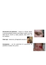 Konspekts 'Ādas slimības, kas skar sejas ādu', 13.