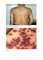 Konspekts 'Kapoši sarkoma', 4.