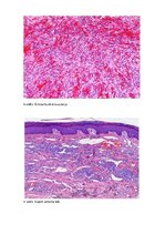 Konspekts 'Kapoši sarkoma', 6.