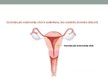 Prezentācija 'Dzemdes ķermeņa jeb endometrija vēzis', 2.