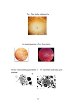 Referāts 'Teja-Saki slimība', 11.