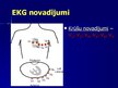 Prezentācija 'EKG pamati, dzīvībai bīstamie ritmi', 6.