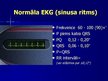 Prezentācija 'EKG pamati, dzīvībai bīstamie ritmi', 15.