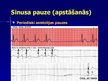 Prezentācija 'EKG pamati, dzīvībai bīstamie ritmi', 19.