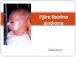 Prezentācija 'Pjēra Robēna sindroms', 1.