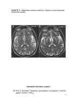Referāts 'Kreicfelda - Jakoba slimība', 7.