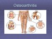 Prezentācija 'Osteoarthritis', 1.