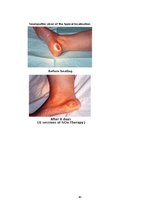 Diplomdarbs 'Dzīves kvalitāti ietekmējošie faktori pacientiem ar trofiskām čūlām', 60.