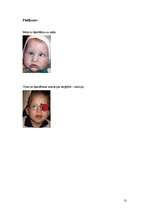 Referāts 'Šķielēšana', 13.