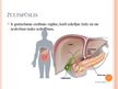 Prezentācija 'Žultspūšļa un žultsceļu ķirurģiskās slimības', 2.