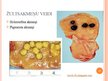 Prezentācija 'Žultspūšļa un žultsceļu ķirurģiskās slimības', 11.