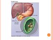 Prezentācija 'Žultspūšļa un žultsceļu ķirurģiskās slimības', 22.