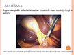 Prezentācija 'Žultspūšļa un žultsceļu ķirurģiskās slimības', 51.