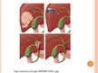 Prezentācija 'Žultspūšļa un žultsceļu ķirurģiskās slimības', 64.