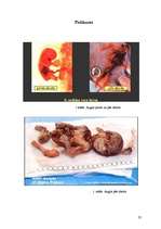 Referāts 'Aborts, aborta veidi, neauglība, aborta sekas', 23.