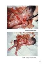 Referāts 'Aborts, aborta veidi, neauglība, aborta sekas', 24.