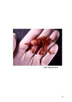 Referāts 'Aborts, aborta veidi, neauglība, aborta sekas', 27.