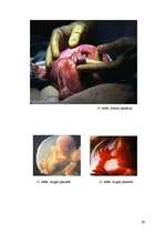 Referāts 'Aborts, aborta veidi, neauglība, aborta sekas', 29.