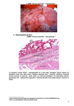 Konspekts 'Fibrinozs perikardīts', 4.
