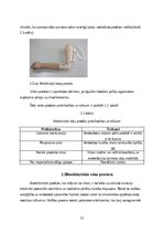 Referāts 'Roku protēzes', 12.