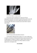 Referāts 'Roku protēzes', 18.