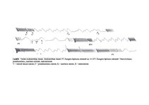 Paraugs 'Sirds fizioloģija, sirds automātija', 5.