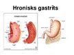 Prezentācija 'Hronisks gastrīts', 1.