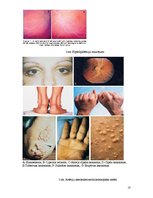 Referāts 'Hiperlipidēmija un aptaukošanās', 18.