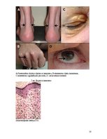 Referāts 'Hiperlipidēmija un aptaukošanās', 20.