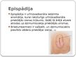 Prezentācija 'Hipospādija un epispādija', 15.