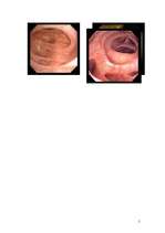 Referāts 'Resnās zarnas divertikuloze', 5.