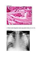 Referāts 'Plaušu tūska', 12.