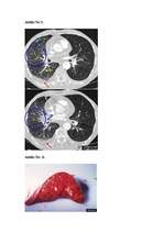 Referāts 'Plaušu tūska', 13.