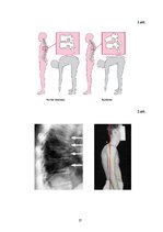 Referāts 'Šoermaņa slimība', 27.