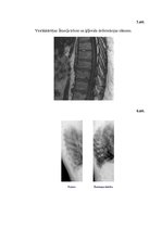 Referāts 'Šoermaņa slimība', 29.