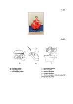 Referāts 'Šoermaņa slimība', 33.