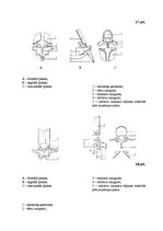 Referāts 'Šoermaņa slimība', 34.
